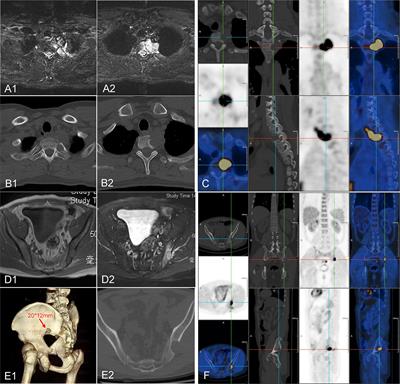 Promising clinical outcome after body gamma knife radiotherapy for mediastinal follicular dendritic cell sarcoma with thoracic spine invasion and iliac metastasis: A case report and literature review